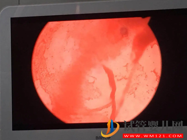 二胎38周剖腹產后遺癥太多！產后每天都在后悔(圖3)