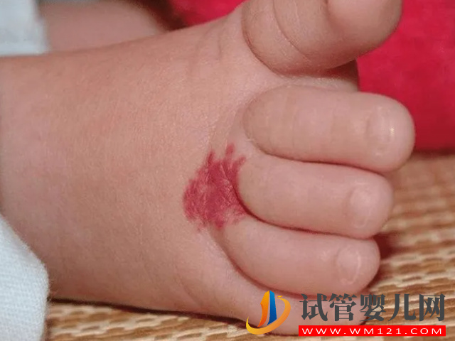 兒童不同位置胎記圖解大全，是福是禍點(diǎn)看看了才知道(圖1)