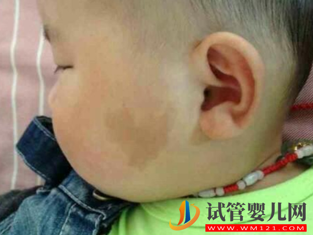 兒童不同位置胎記圖解大全，是福是禍點(diǎn)看看了才知道(圖3)