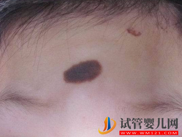 兒童不同位置胎記圖解大全，是福是禍點(diǎn)看看了才知道(圖4)