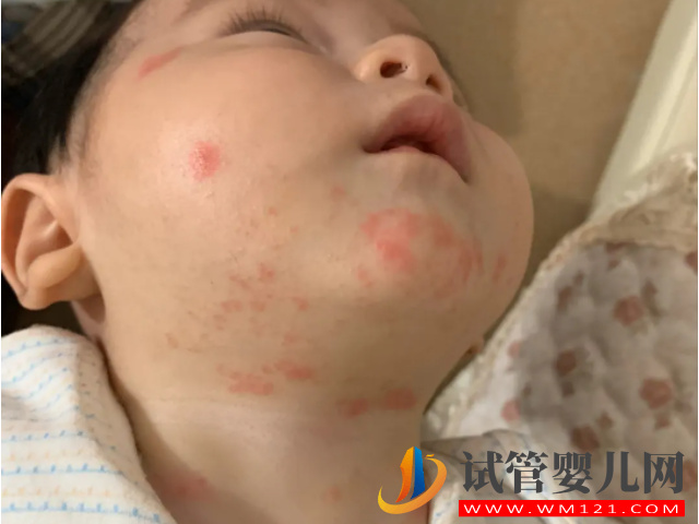 新生兒臉上冒濕疹不用慌，家庭護理小妙招輕松處理(圖3)