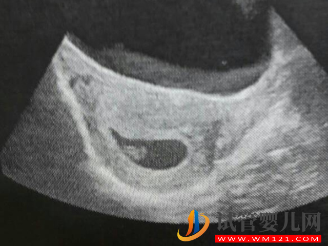 b超監(jiān)測(cè)有卵黃囊基本是宮內(nèi)妊娠，不管出現(xiàn)早晚都穩(wěn)了(圖3)