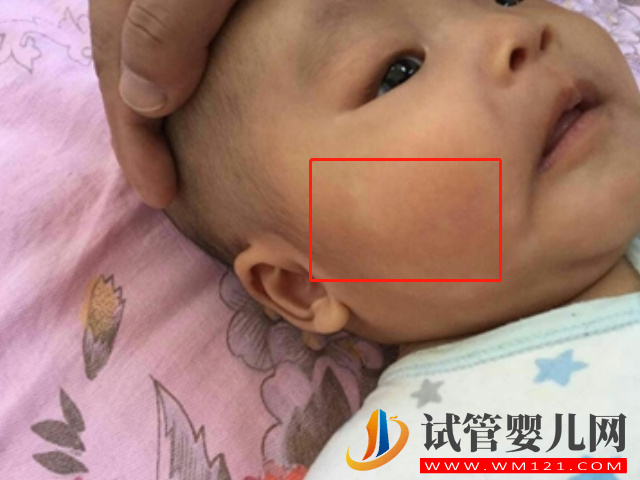 新生兒白色胎記圖片大全，發(fā)病幾率小但危害大(圖2)