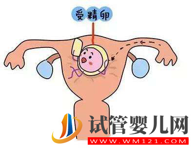 試管嬰兒胚胎移植后腹部兩側疼是不是宮外孕？(圖1)