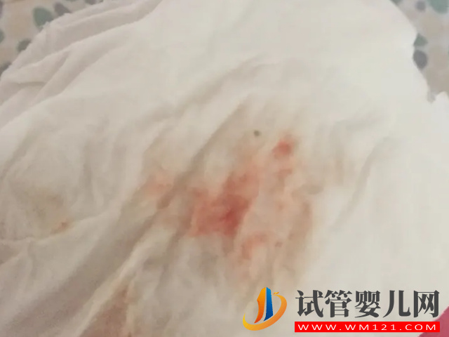 試管取卵對女性卵巢的危害大，術(shù)后出血千萬別大意(圖2)