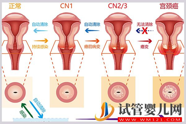 宮頸低度病變lsil可以做試管，但可能影響胚胎著床成功率(圖2)