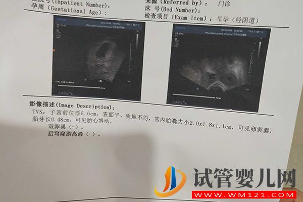 試管移植28天胎心胎芽標準來了，看不見1周后需超聲復查(圖2)