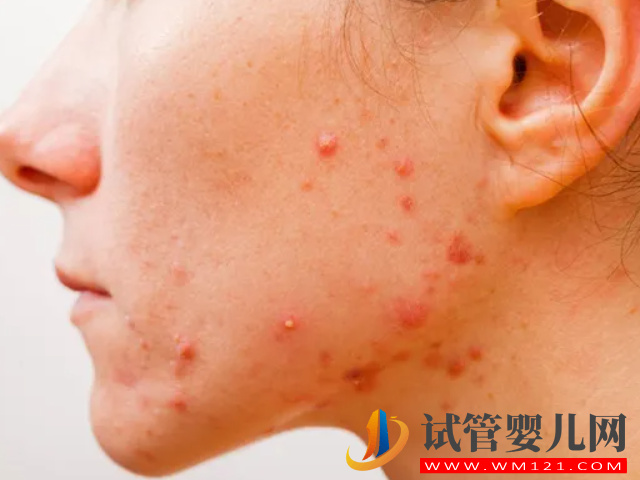 女性多囊長痘和普通長痘有區別，外在表現和癥狀都不一樣(圖2)