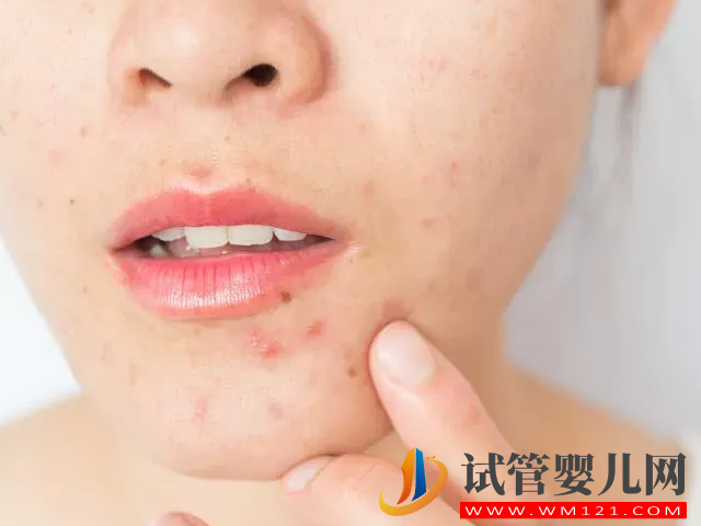 女性多囊長痘和普通長痘有區別，外在表現和癥狀都不一樣(圖3)