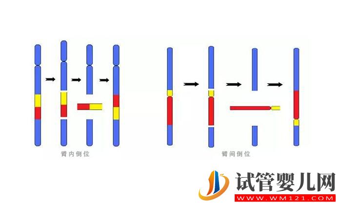 染色體平衡易位能做試管手術嗎 要注意哪些問題(圖2) 染色體平衡易位能做試管手術嗎 要注意哪些問題(圖2)