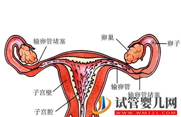 輸卵管積水會對試管嬰兒成功率造成影響嗎?(圖1)