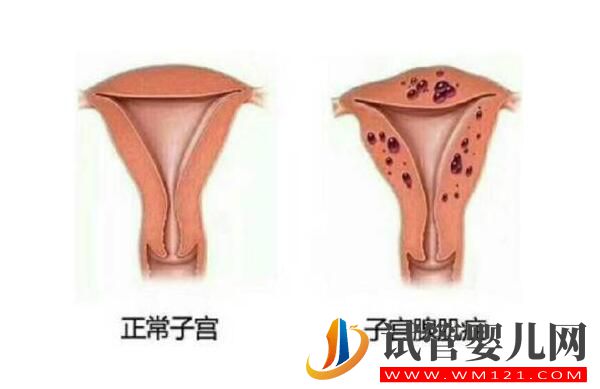 子宮腺肌癥能做試管嬰兒嗎?應該如何備孕(圖1) 子宮腺肌癥能做試管嬰兒嗎?應該如何備孕(圖1)