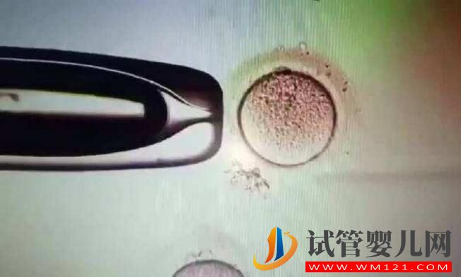 子宮腺肌癥能做試管嬰兒嗎?應該如何備孕(圖4) 子宮腺肌癥能做試管嬰兒嗎?應該如何備孕(圖4)