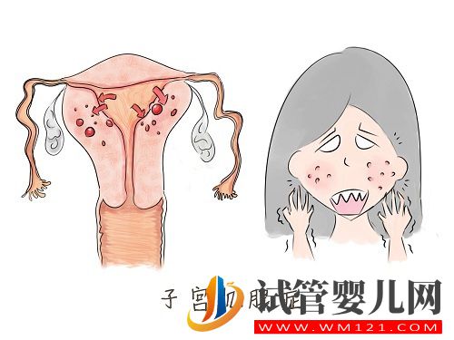 子宮內膜異位癥——痛經的一種常見病因(圖8)
