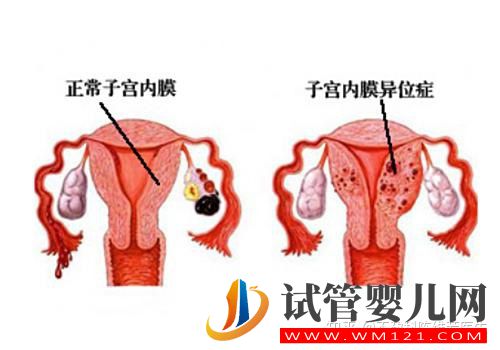 子宮內(nèi)膜異位癥有這4種類型,難怪癥狀不一樣(圖1)