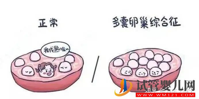 多囊卵巢和多囊卵巢綜合征的區(qū)別是什么(圖1)