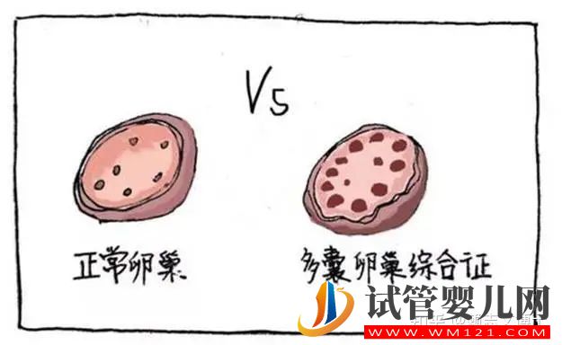 多囊卵巢和多囊卵巢綜合征的區(qū)別是什么(圖2)