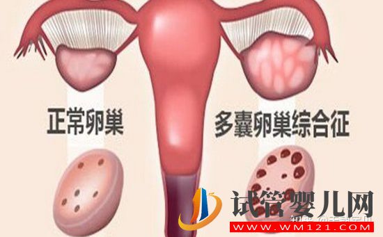 多囊卵巢綜合征六個表現(圖1)