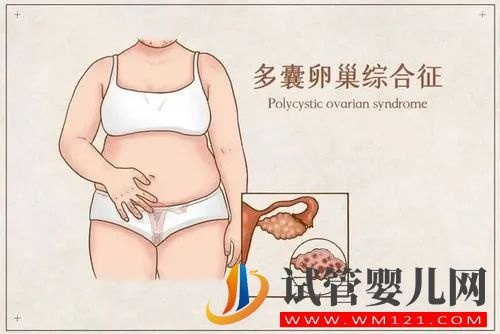 多囊卵巢初期都有什么癥狀(圖1)
