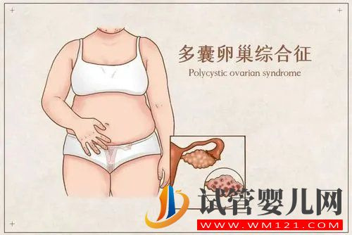 多囊卵巢的原因有哪些？(圖1)