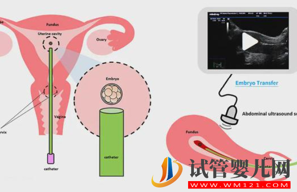 試管人工移植凍胚周期是什么流程，具體步驟有4個(圖1)