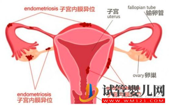 子宮內膜異位癥是什么(圖1)