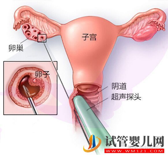 卵子是怎么取出來的_揭秘取卵過程(圖1)