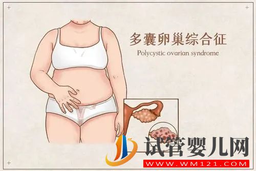 為什么會患上多囊卵巢(圖1)
