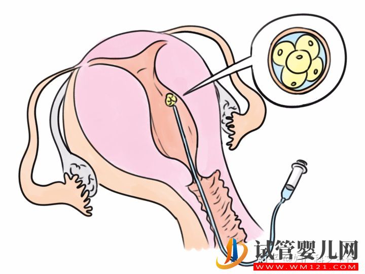試管適應(yīng)癥_第一代試管嬰兒(圖1)