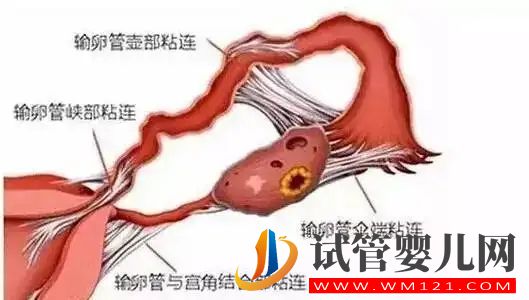 輸卵管粘連怎么檢查(圖1)