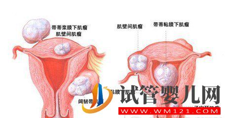 輸卵管通液和輸卵管造影有什么區別(圖1)