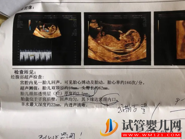 孕13周NT男孩女孩區(qū)別圖，內(nèi)附已生寶媽們nt值作參考(圖1)