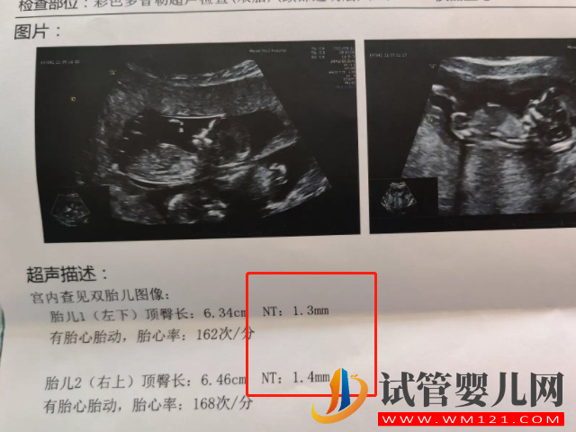 孕13周NT男孩女孩區(qū)別圖，內(nèi)附已生寶媽們nt值作參考(圖2)