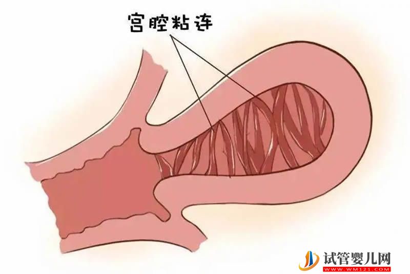 宮腔粘連嚴重，試管3次不成功原因分析(圖1)