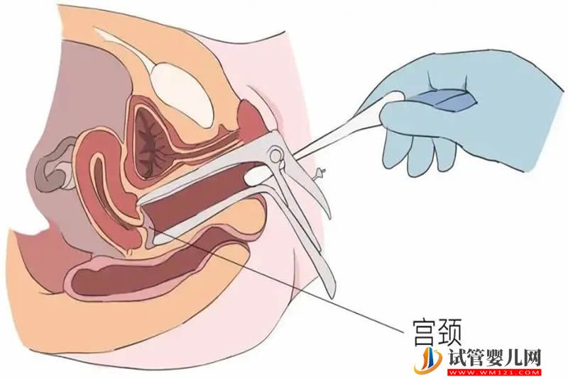 宮腔粘連嚴重，試管3次不成功原因分析(圖2)