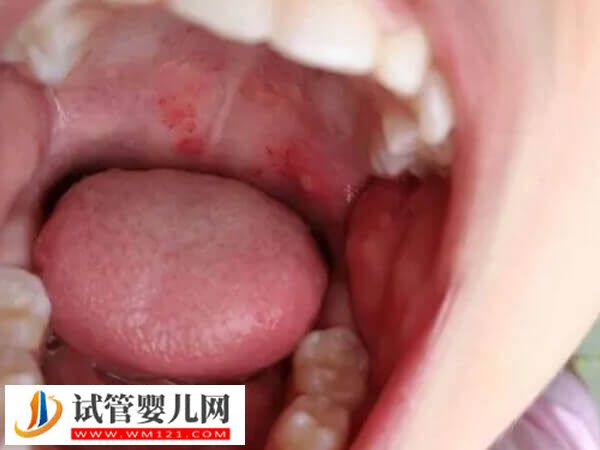 移植后得了口腔潰瘍的原因是什么(圖1)
