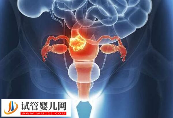 試管嬰兒移植后卵巢囊腫怎么辦(圖1)