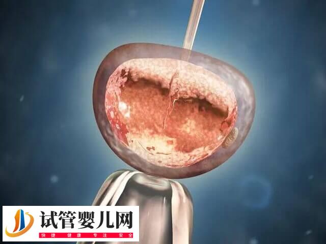 凍胚移植前要做哪些準備(圖1)