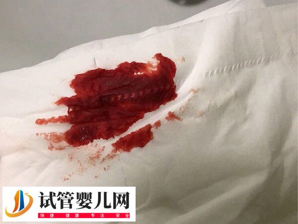 取卵后有淤血塊流出正不正常(圖2)