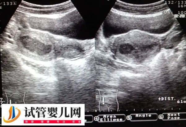 試管為什么有的人一次成功(圖2)