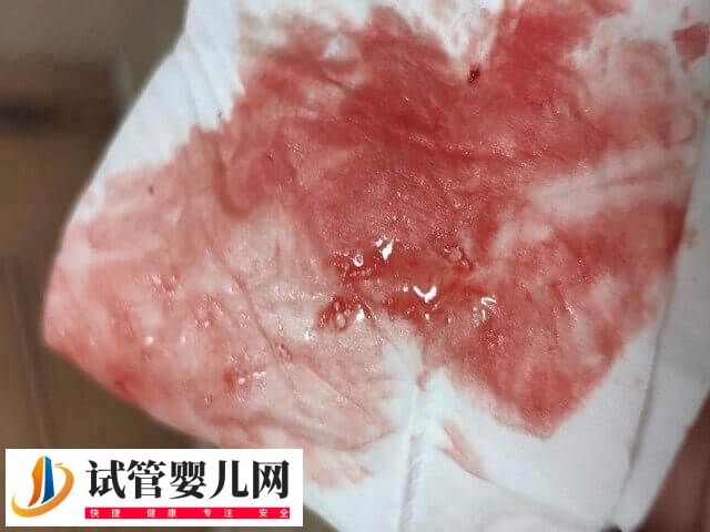 囊胚移植失敗有什么癥狀(圖1)
