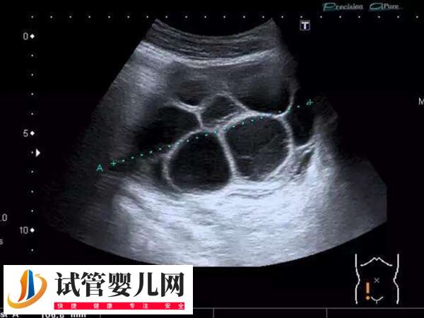 移植完胚胎后為什么腹水(圖1)