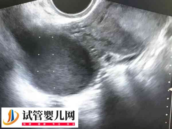 子宮腺肌癥移植能否2個(gè)鮮胚懷雙胎(圖2)