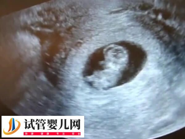 試管嬰兒檢查NT會不會有問題
